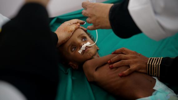 Yemen Malnutrition Boy